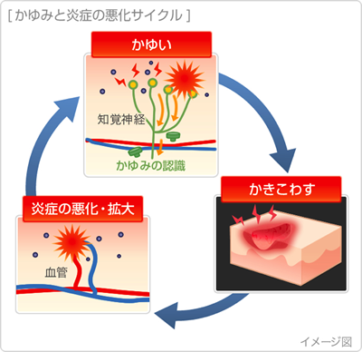 アトピー性皮膚炎