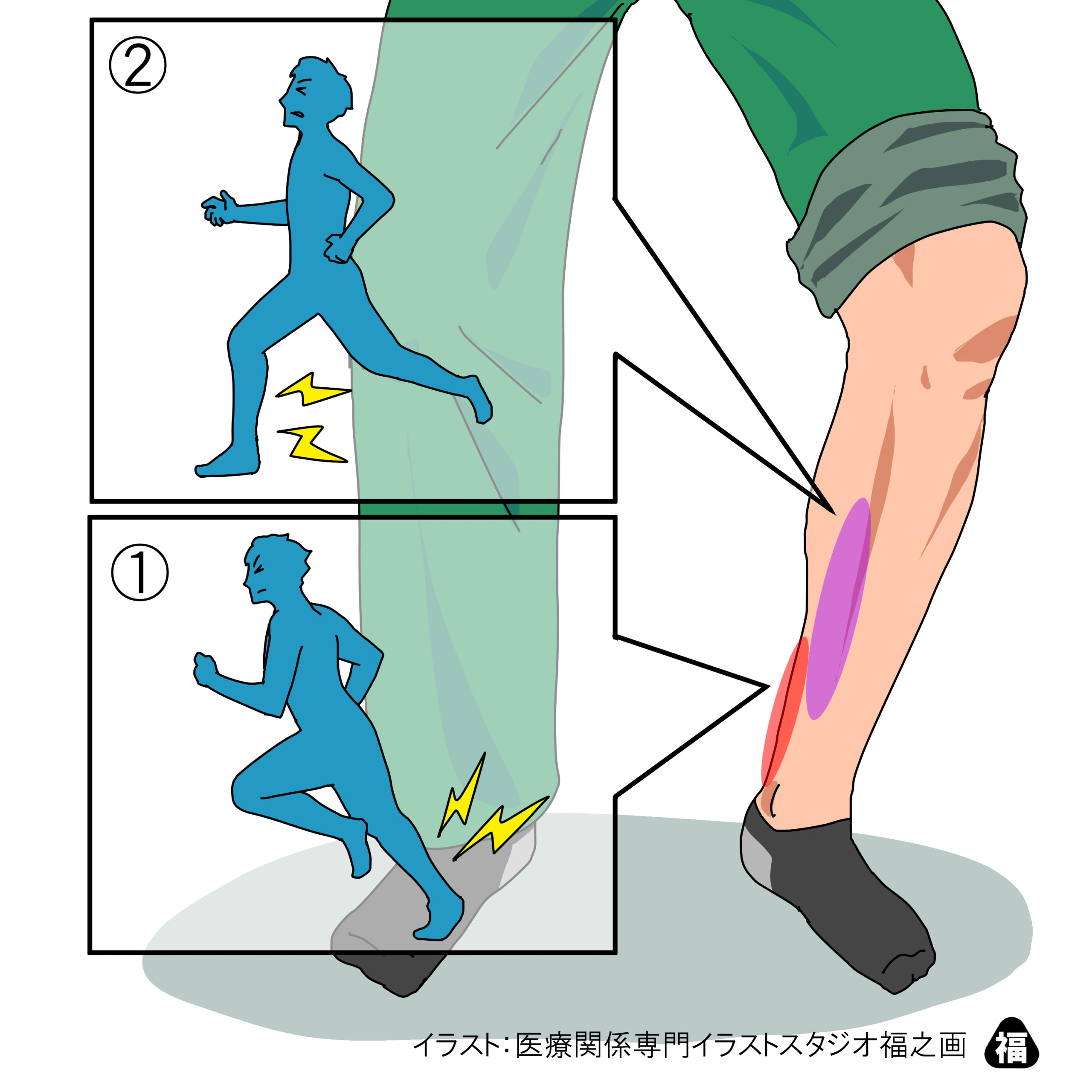 スネの内側が痛い 茂澤メディカルクリニック 公式 南千住駅3分 内科 皮膚科 リハビリテーション科 整形外科