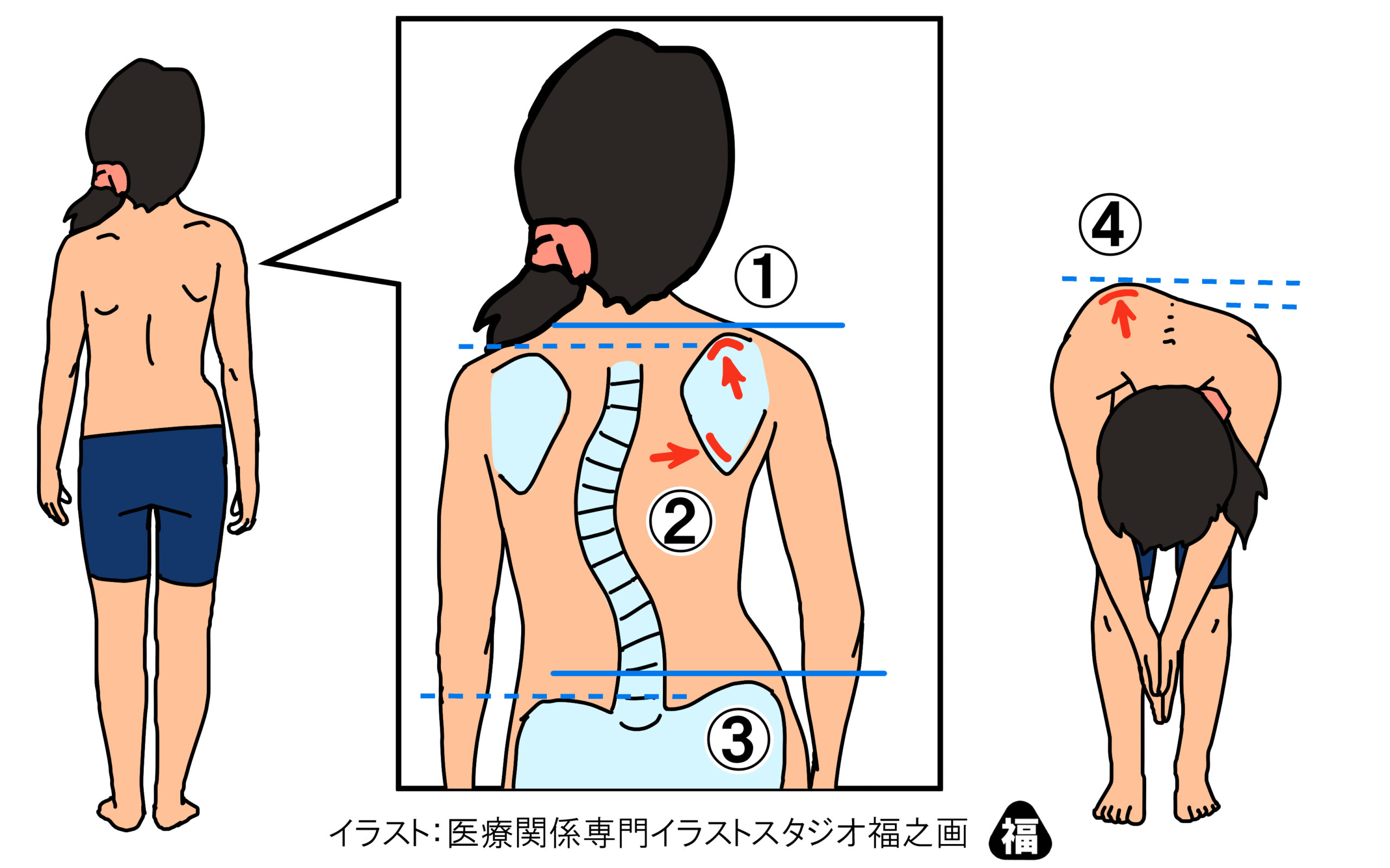 背骨が曲がっている 茂澤メディカルクリニック 公式 南千住駅3分 内科 皮膚科 リハビリテーション科 整形外科