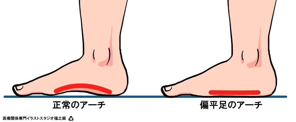 扁平足とは 茂澤メディカルクリニック 公式 南千住駅3分 内科 皮膚科 リハビリテーション科 整形外科
