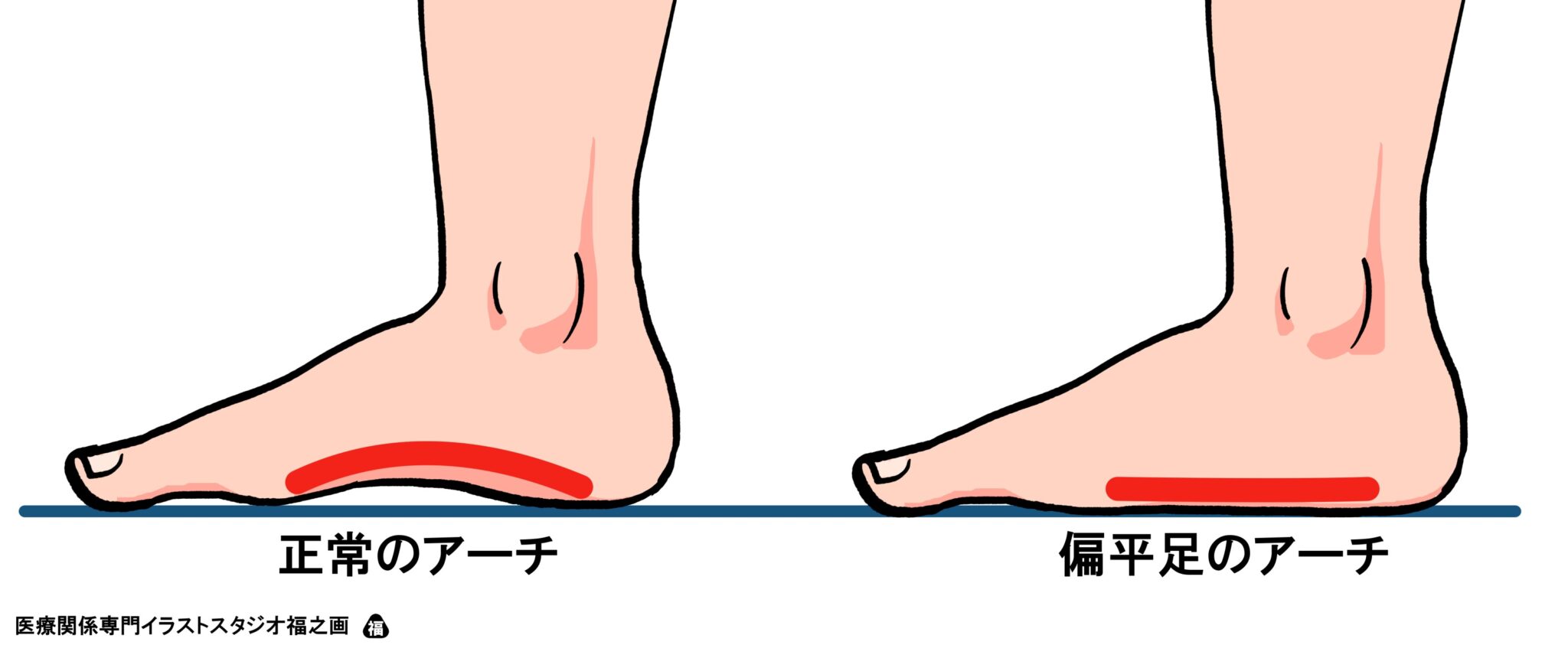 扁平足とは | 茂澤メディカルクリニック南千住【公式】荒川区 内科 皮膚科 リハビリテーション科 整形外科