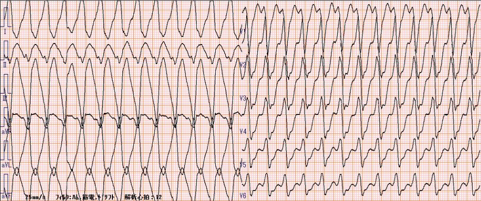 心室頻拍