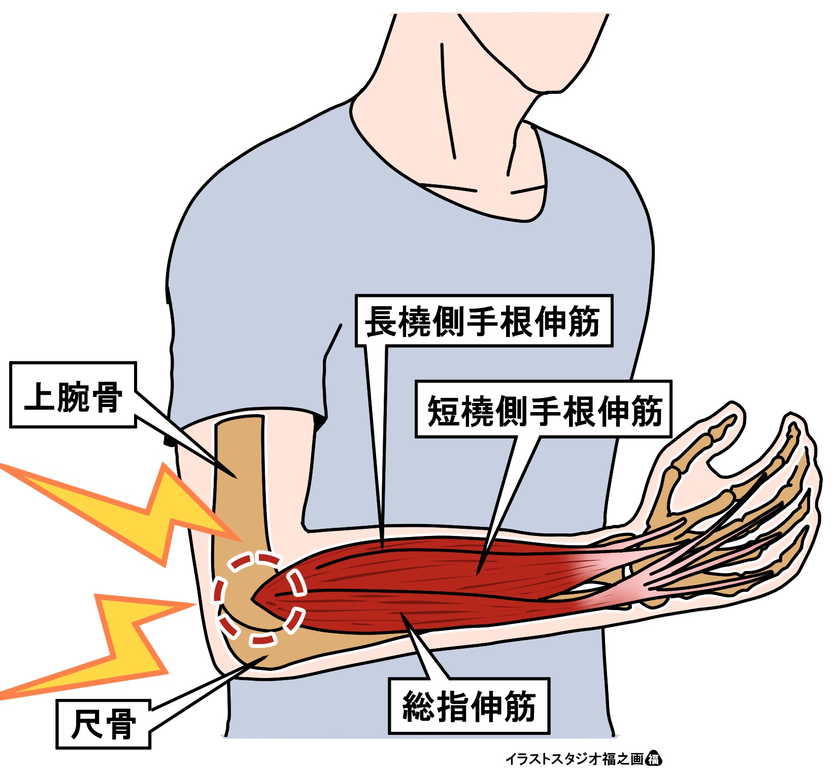 冷える と 肘 が 痛い